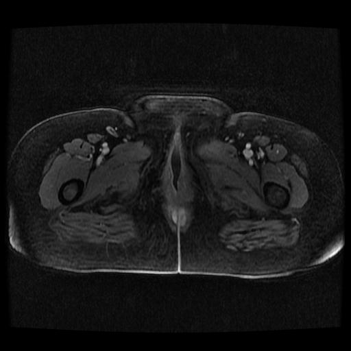 Cervical carcinoma (Radiopaedia 70924-81132 Axial T1 C+ fat sat 192).jpg