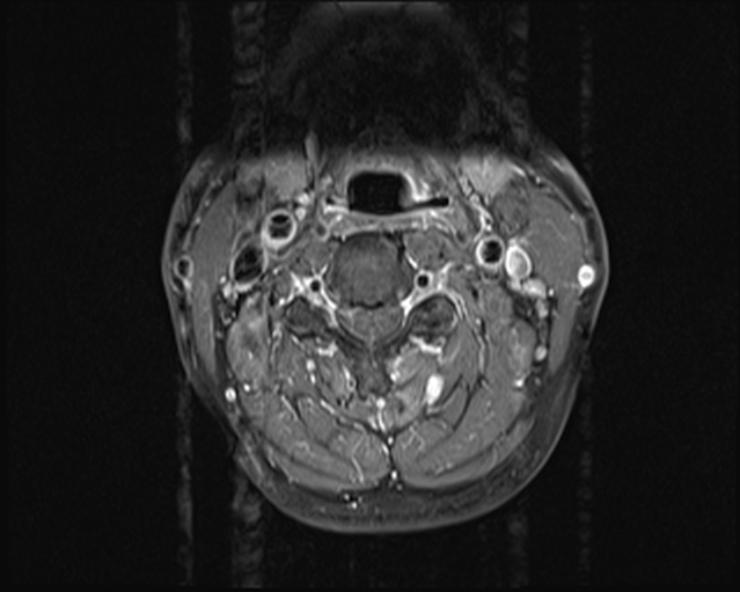 File:Cervical disc extrusion (Radiopaedia 53950-60077 Axial T1 C+ fat sat 8).jpg