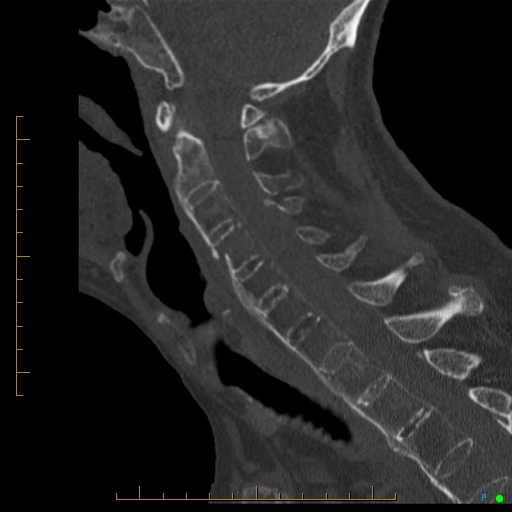 File:Cervical spine fracture - ankylosing spondylitis (Radiopaedia 76835-88706 Sagittal bone window 56).jpg