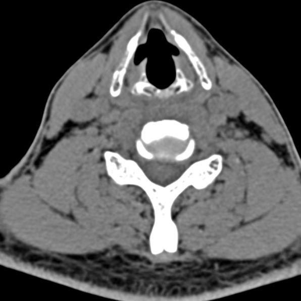 Cervical spondylodiscitis (Radiopaedia 28057-29489 Axial non-contrast 50).jpg