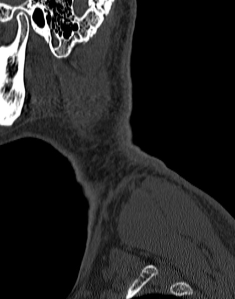 Cervical spondylodiscitis (Radiopaedia 28057-29489 Sagittal bone window 5).jpg
