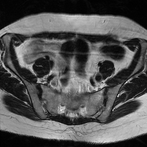 File:Cesarian section scar endometriosis (Radiopaedia 66520-75799 Axial T2 3).jpg