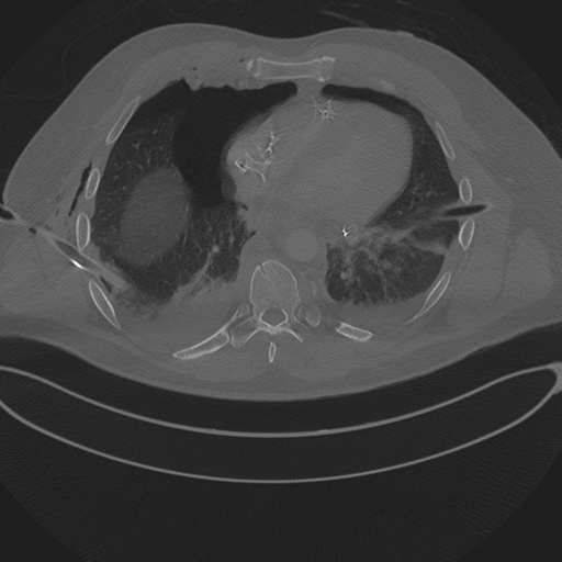 Chest multitrauma - aortic injury (Radiopaedia 34708-36147 Axial bone window 195).png
