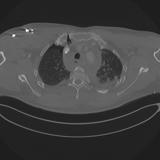 Chest multitrauma - aortic injury (Radiopaedia 34708-36147 Axial bone window 70).png