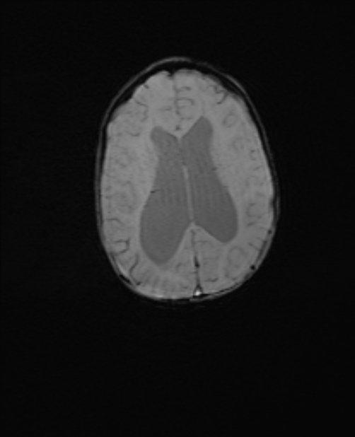 Chiari III malformation with occipital encephalocele (Radiopaedia 79446-92559 Axial SWI 43).jpg