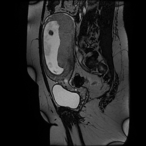 Chiari II malformation - fetal MRI (Radiopaedia 68099-77581 Sagittal Fiesta 36).jpg