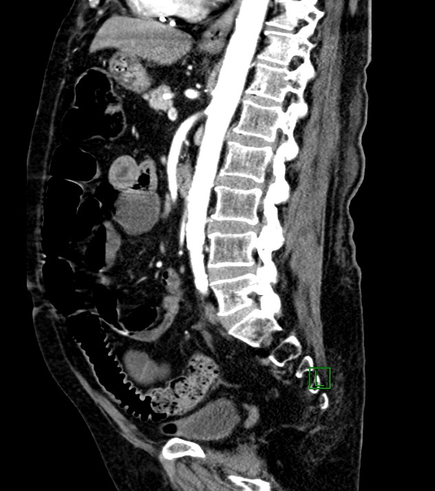 Cholangiocarcinoma with cerebral metastases (Radiopaedia 83519-98629 F 57).jpg
