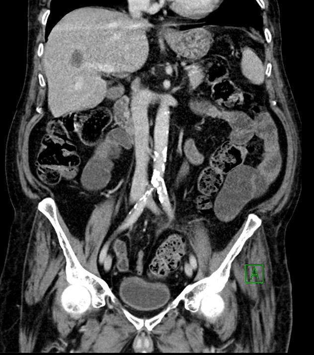 Cholangiocarcinoma with cerebral metastases (Radiopaedia 83519-98629 G 41).jpg