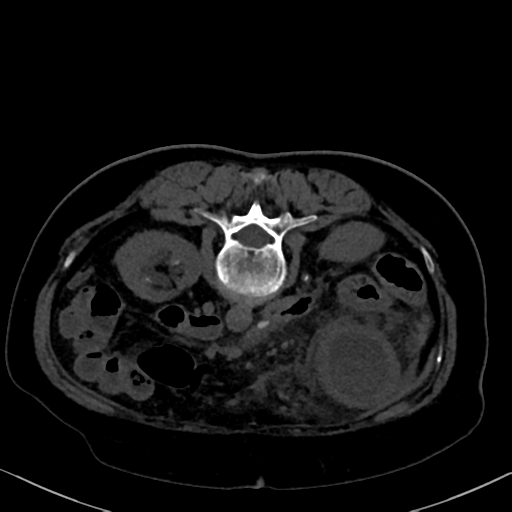 File:Cholecystitis - obstructive choledocholitiasis (CT intravenous cholangiography) (Radiopaedia 43966-47479 Axial 38).png