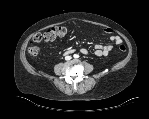 Cholecystoduodenal fistula (Radiopaedia 48959-54022 A 9).jpg