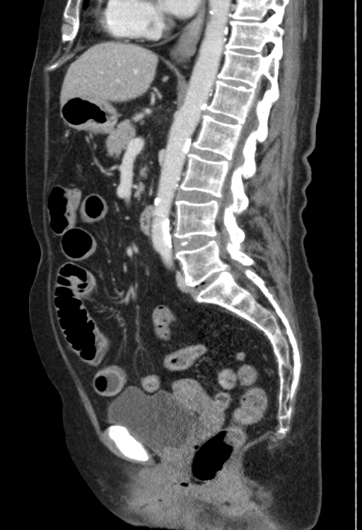 Cholecystoduodenal fistula due to calculous cholecystitis with gallstone migration (Radiopaedia 86875-103077 F 29).jpg