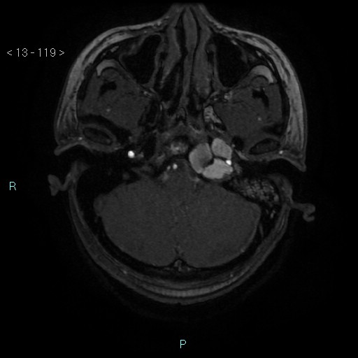 Cholesterol granuloma of the petrous apex (Radiopaedia 64358-73140 Axial TOF 3D 58).jpg