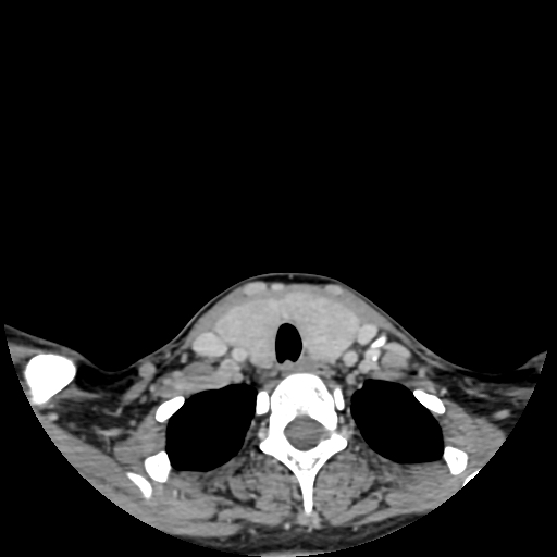 File:Chondroblastic osteosarcoma (Radiopaedia 67363-76741 Axial with contrast 3).jpg