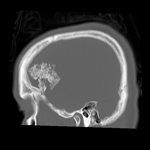 File:Chondrosarcoma - sphenoid wing (Radiopaedia 58259-67828 Sagittal bone window 24).jpg