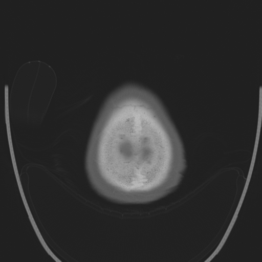 Chondrosarcoma of skull base- grade II (Radiopaedia 40948-43653 Axial bone window 49).png