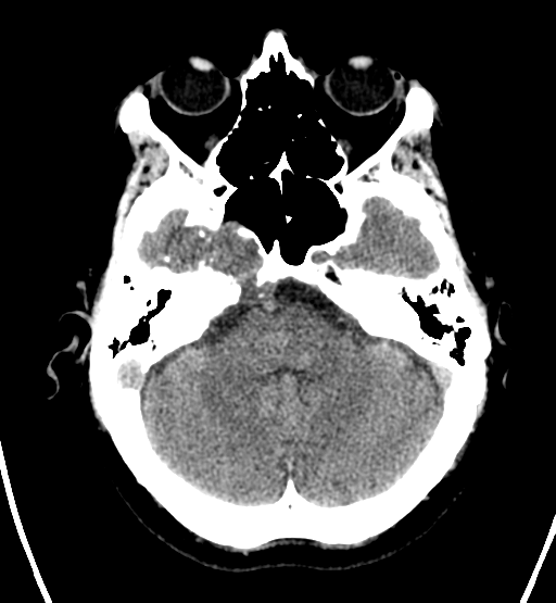 File:Chondrosarcoma of skull base- grade II (Radiopaedia 40948-43653 Axial non-contrast 7).png