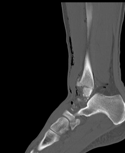 Chopart fracture (Radiopaedia 35347-36851 Sagittal bone window 41).jpg