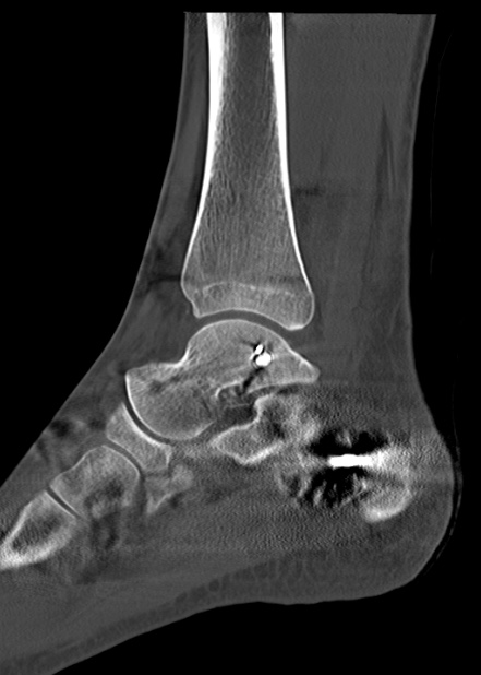 Chopart fracture (Radiopaedia 35347-36861 Sagittal bone window 42).jpg