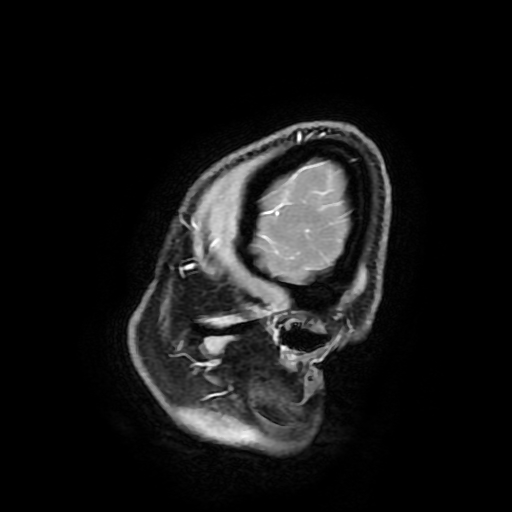 Chordoid glioma of third ventricle (Radiopaedia 91612-109340 F 25).jpg
