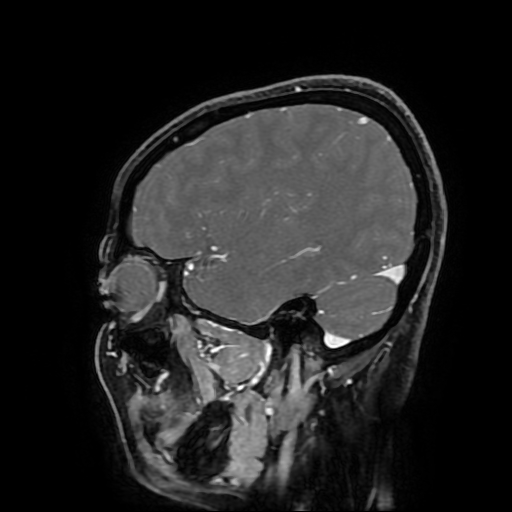 Chordoid glioma of third ventricle (Radiopaedia 91612-109340 F 60).jpg