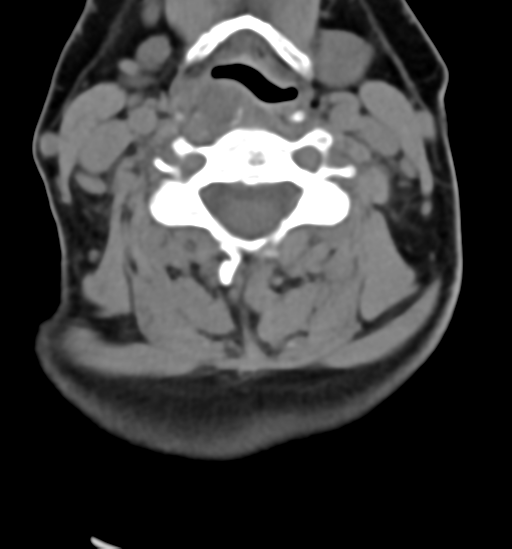 File:Chordoma (C4 vertebra) (Radiopaedia 47561-52188 Axial non-contrast 28).png
