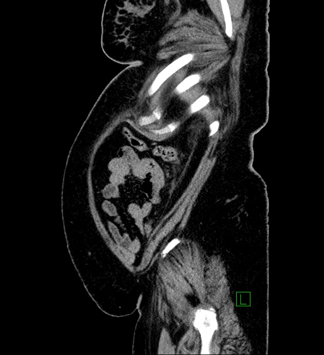 Chromophobe renal cell carcinoma (Radiopaedia 84239-99519 G 18).jpg