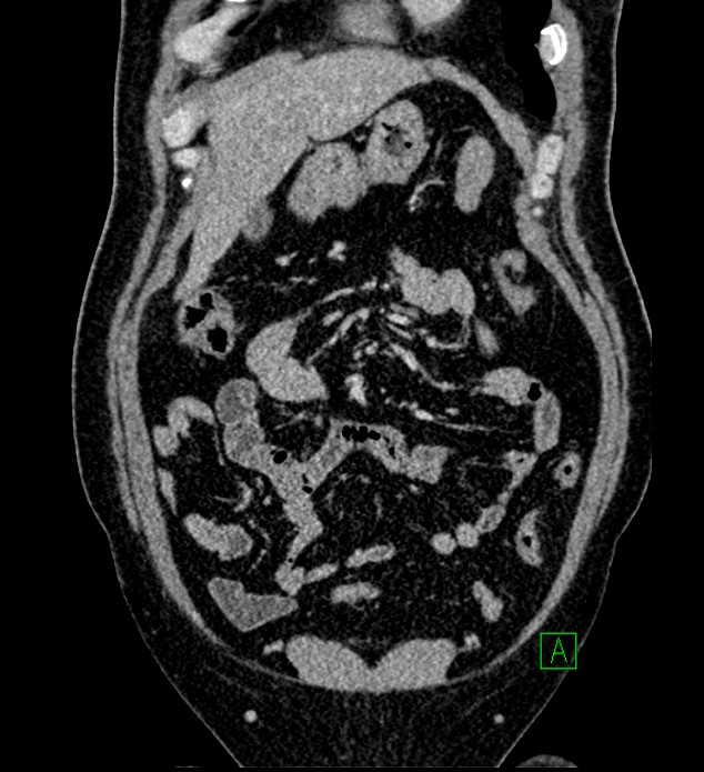 Chromophobe renal cell carcinoma (Radiopaedia 84286-99573 H 47).jpg