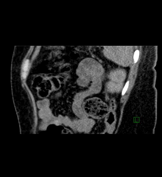 Chromophobe renal cell carcinoma (Radiopaedia 84290-99582 D 19).jpg