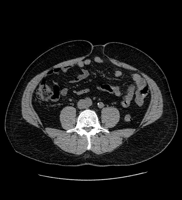 Chromophobe renal cell carcinoma (Radiopaedia 84337-99693 Axial non-contrast 93).jpg