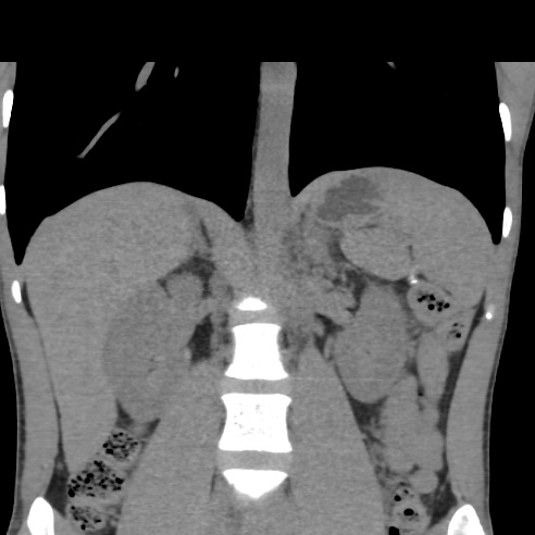 File:Chronic calcific pancreatitis (Radiopaedia 56280-62953 Coronal non-contrast 19).jpg