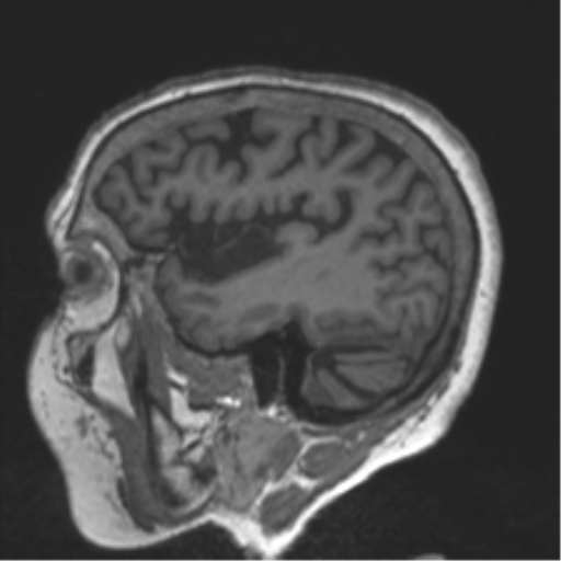 File:Chronic hypertensive encephalopathy (Radiopaedia 39993-42482 Sagittal T1 25).png