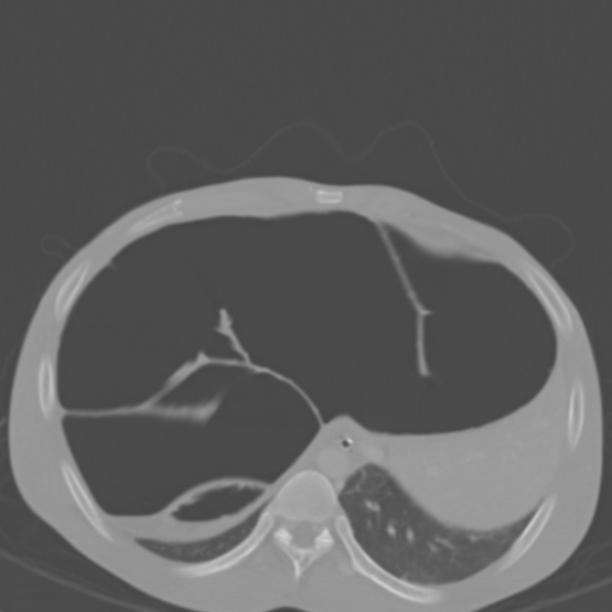 Chronic large bowel pseudo-obstruction (Radiopaedia 43181-46492 Axial bone window 38).jpg