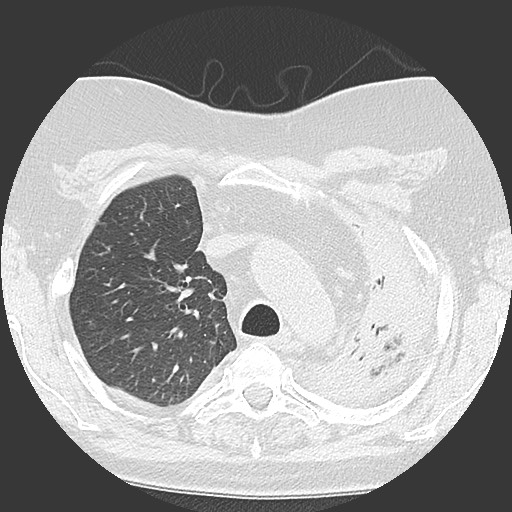 Chronic lung allograft dysfunction - restrictive form (Radiopaedia 60595-68316 Axial lung window 19).jpg