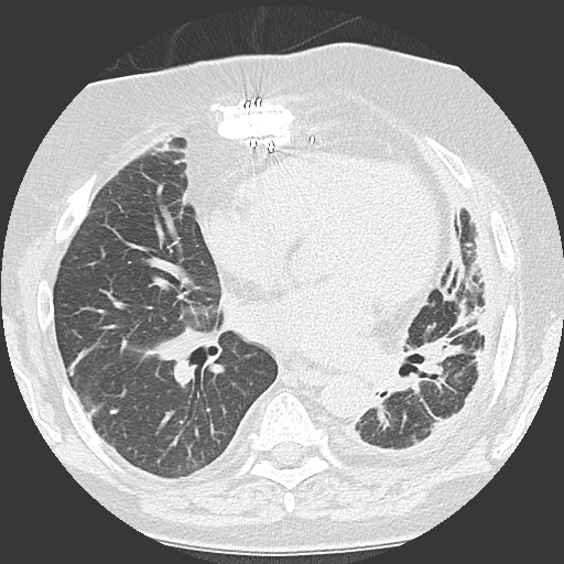 Chronic lung allograft dysfunction - restrictive form (Radiopaedia 60595-68316 Axial lung window 39).jpg