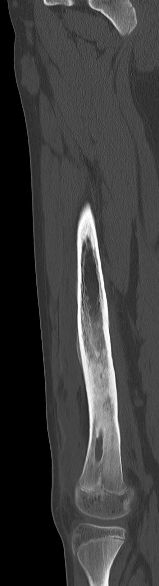 Chronic ostemyelitis of the femur with long sinus tract (Radiopaedia 74947-85982 Sagittal bone window 48).jpg