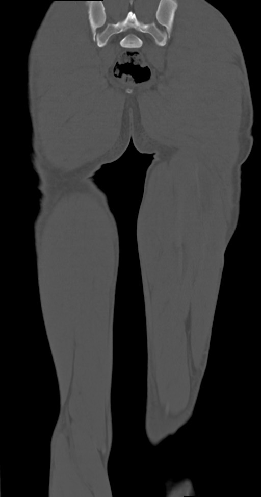 Chronic osteomyelitis (with sequestrum) (Radiopaedia 74813-85822 Coronal non-contrast 48).jpg