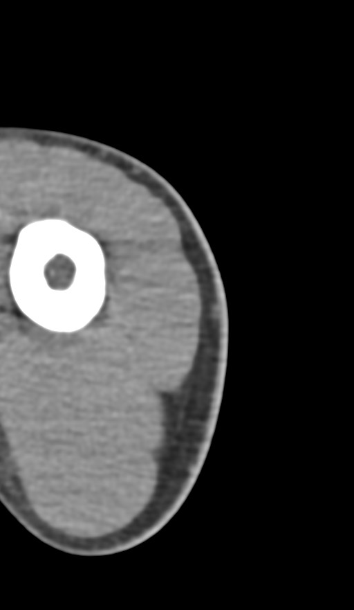 Chronic osteomyelitis of the distal humerus (Radiopaedia 78351-90971 Axial non-contrast 1).jpg