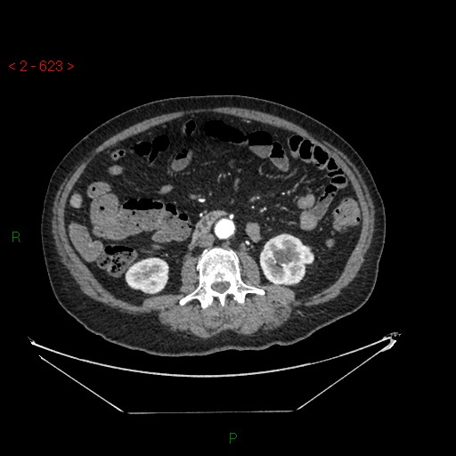 File:Circumaortic left renal vein and doubled left renal arteries (Radiopaedia 52268-58158 A 159).jpg
