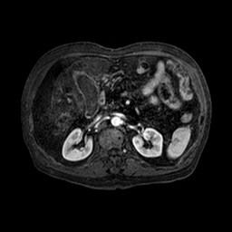 File:Cirrhosis and hepatocellular carcinoma in the setting of hemochromatosis (Radiopaedia 75394-86594 Axial T1 C+ fat sat 113).jpg