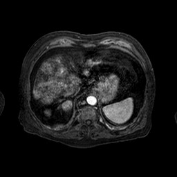 File:Cirrhosis and hepatocellular carcinoma in the setting of hemochromatosis (Radiopaedia 75394-86594 Axial T1 C+ fat sat 144).jpg