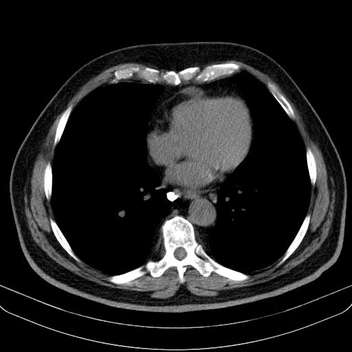 Classic complicated silicosis (Radiopaedia 49720-54961 Axial liver window 36).jpg
