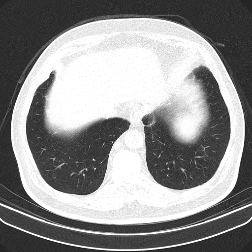 Classic complicated silicosis (Radiopaedia 49720-54961 Axial lung window 49).jpg