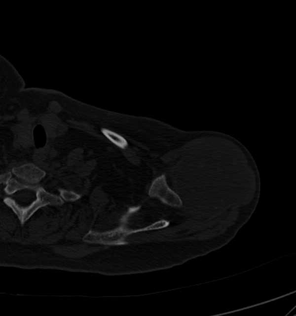 Clear cell chondrosarcoma - humerus (Radiopaedia 63104-71612 Axial bone window 22).jpg