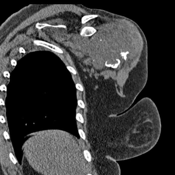 Clear cell chondrosarcoma - humerus (Radiopaedia 63104-71612 Coronal non-contrast 39).jpg