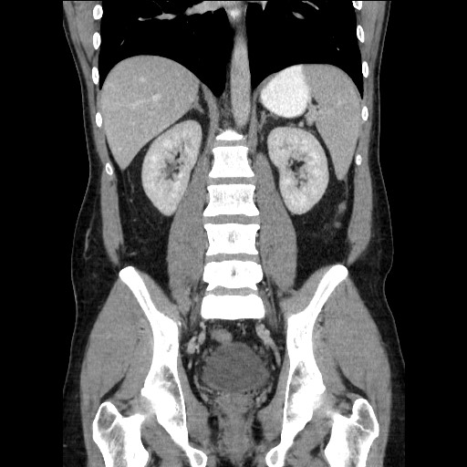 Closed-loop small bowel obstruction (Radiopaedia 73713-84509 C 80).jpg