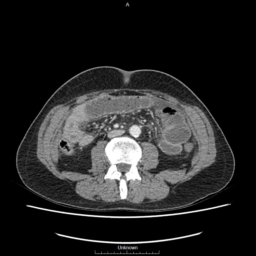 Closed loop bowel obstruction and ischemia (Radiopaedia 86959-103180 A 43).jpg