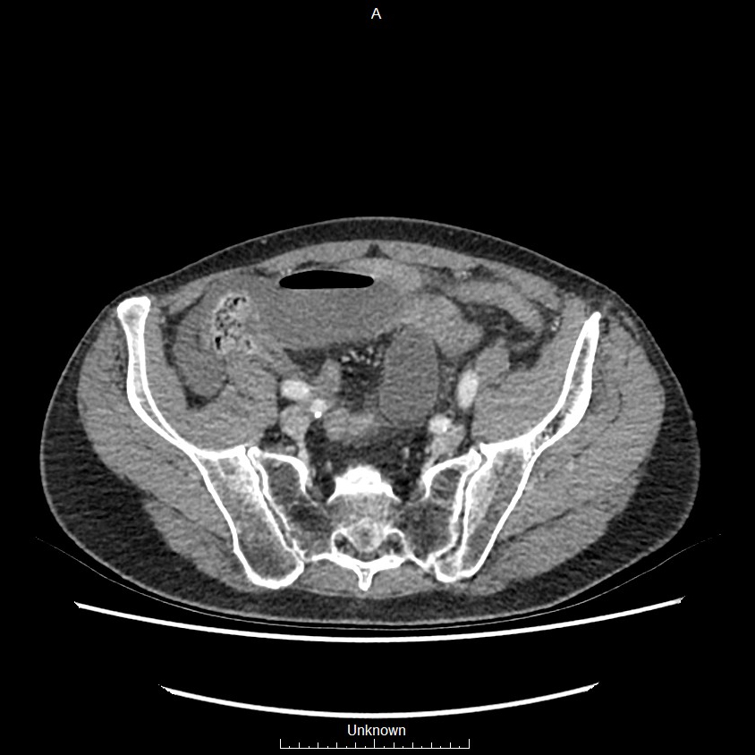 Closed loop bowel obstruction and ischemia (Radiopaedia 86959-103180 A 67).jpg