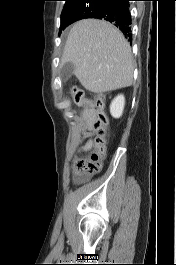 Closed loop bowel obstruction and ischemia (Radiopaedia 86959-103180 C 57).jpg