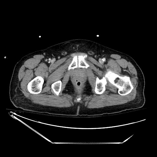 File:Closed loop obstruction due to adhesive band, resulting in small bowel ischemia and resection (Radiopaedia 83835-99023 D 158).jpg