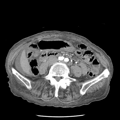 Closed loop small bowel obstruction - adhesions and infarct (Radiopaedia 85125-100678 A 105).jpg